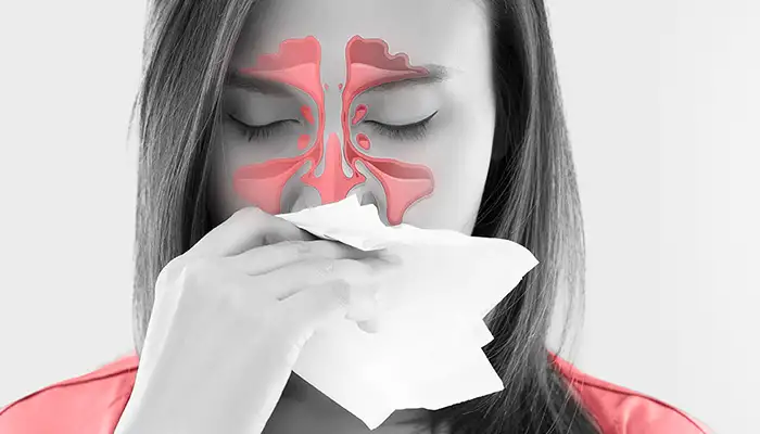 Риносинусит - лечение в Мастерслух Риносинусит - лечение в Мастерслух