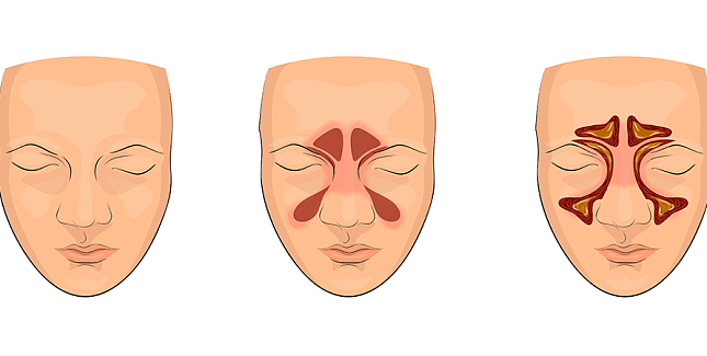 Риносинусит