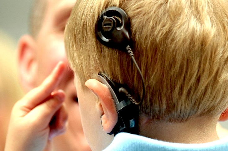 Кохлеарная имплантация