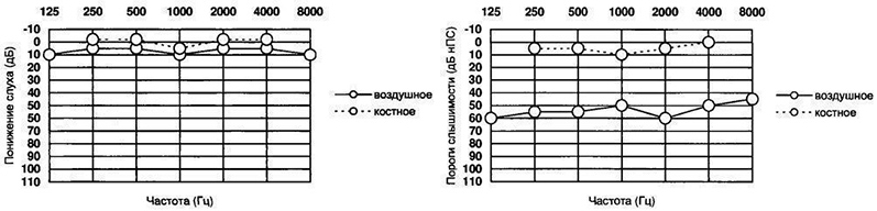 Тональная аудиометрия - данные для исследования