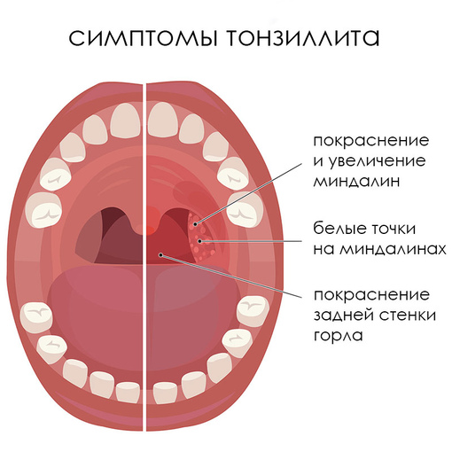 Симптомы тонзиллита