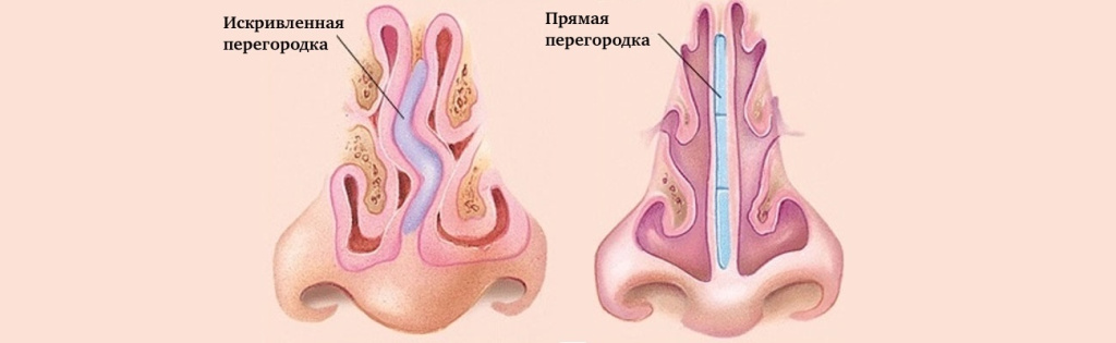 септопластика